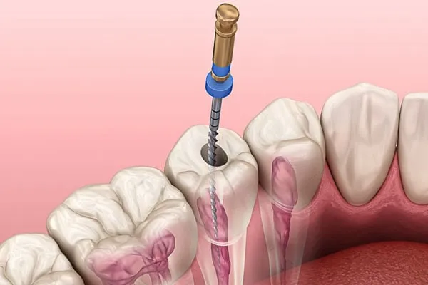 Ilustração 3D de tratamento de canal: lima endodôntica introduzida no canal de um molar, com os canais destacados