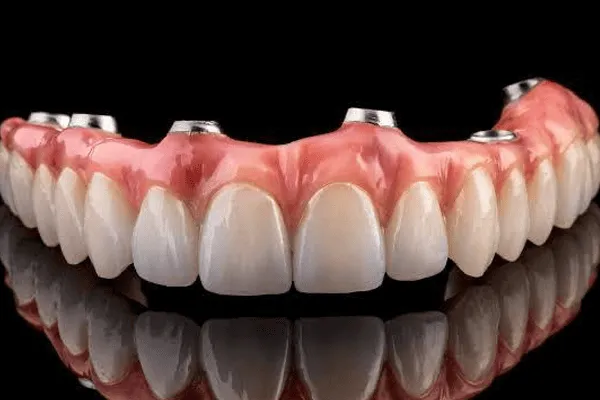Ilustração de prótese total sobre implantes, com os pilares metálicos visíveis na base