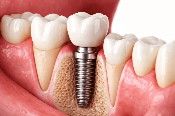 Ilustração 3D de implante dentário: pino de titânio fixado no osso entre dentes naturais, com a coroa sendo posicionada