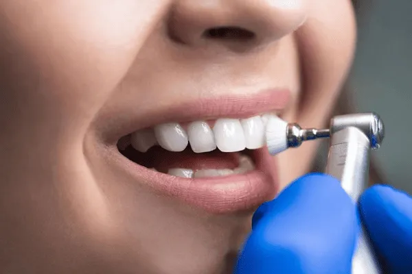 Ilustração de limpeza dental: taça de profilaxia com pasta sendo aplicada sobre os dentes de uma paciente
