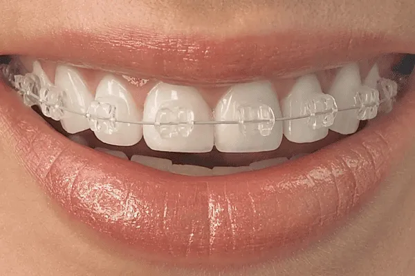 Ilustração de sorriso com aparelho ortodôntico estético: braquetes transparentes com fio metálico