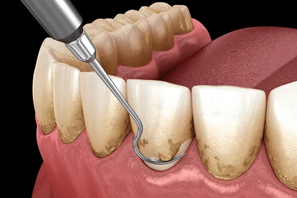Ilustração 3D de raspagem periodontal: cureta removendo tártaro acumulado entre gengiva e dentes