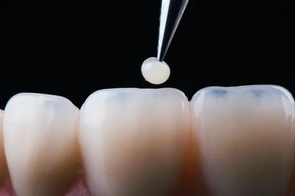 Ilustração de restauração dental: uma porção de resina sendo levada por pinça até a superfície de um dente